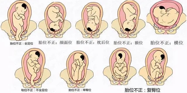 胎位不正是什么原因导致的 胎位不正要注意什么？