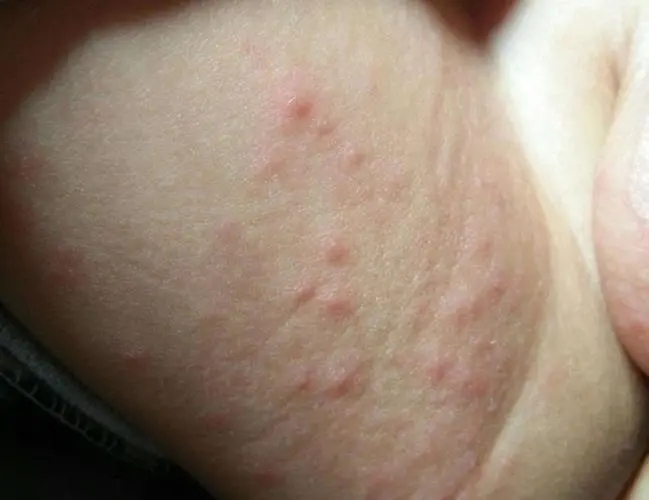 痱子和湿疹怎么区分 盘点痱子和湿疹的4种区别