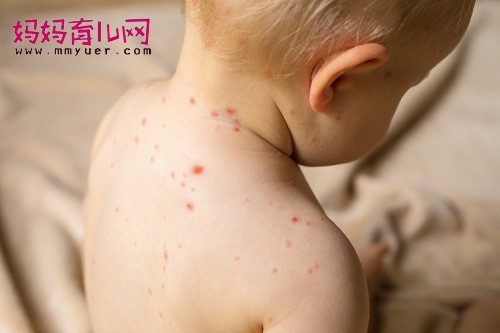 儿童常见皮肤病有哪些 儿童各种常见皮肤病症状对照图
