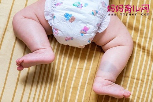 新生儿胎记可以自行消失吗？4种可以自己消退的胎记
