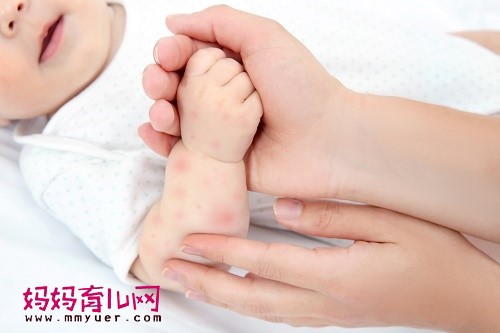 婴儿常见皮肤病有哪些 15种婴儿常见皮肤病
